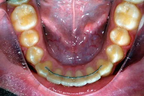 festsitzender retainer